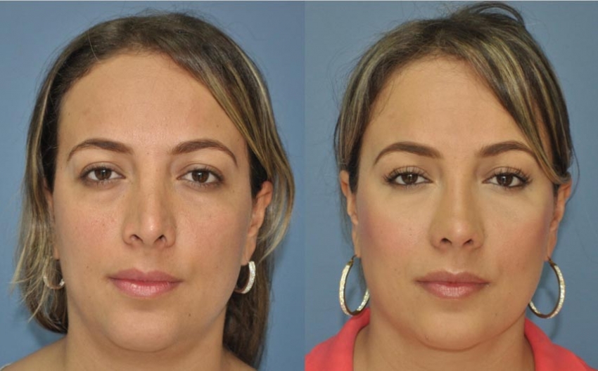 Facial Plastic Surgery rhinoplastyent doctor gilberto